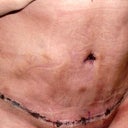 The day after surgery, my first time seeing my new belly.