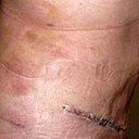 The day after surgery.