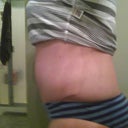 4 weeks post op - lots of swelling still