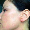 Fifth day, left cheek. This is my driver's cheek: I noticed more sun damage here ever since I started a job requiring a 40-minute drive each way. The sun gets that cheek in the morning. The brown spots seem reduced but they're still there to my eye. I do feel at this point I could go out without foundation, which I never felt comfortable doing before.
