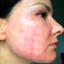Fifth day, right cheek. Very flawless result, if we disregard the redness. I do feel itchiness, like it's irritated by a new product. Not unbearable though.