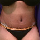 1 week post op