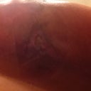 Sore spot 1 1/2 weeks later