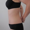 3 weeks post-op side view