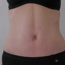 3 weeks post-op front view