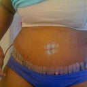 4 days post-op... Very swollen and the drain is still needed. I only have drain but can't wait til it's gone.