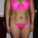 Before surgery, I can't believe I lived with all this skin for so man years!