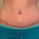 Almost 9 wks po. My scar, healing nicely. Almost 9wks post op. still pulling my BB over due to the swelling on my left side. Pleating has flattened out quite a bit.