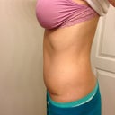 Almost 9wks po. Not bad, still obviously swollen compared to other side.