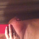 15 DAYS POST OP