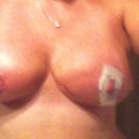 15 DAYS POST OP