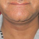 Disfigured lips and toothless appearance after Chin Implant