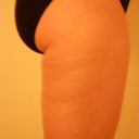 Before - right side