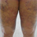 5 days after the procedure - lots of bruising and swelling!