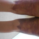 5 days after the procedure - back side, ouch!