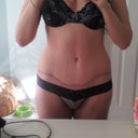 PO 4 mos - showing scar which is actually starting to fade, even though you can't really tell from the pic...