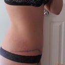 PO 4 mos - side scar