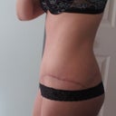 PO 4 mos - side scar