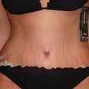 stretch marks starting to blend in