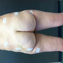 Exactly 4 weeks (28 days) PO. The lipo swelling has come down quite a bit, and there is quite a difference especially from behind.