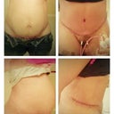 before and after tummy tuck