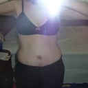 3 weeks 2 days post-op, front view