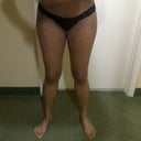 Day 9, Abdomen really swollen. Legs still looks the same.