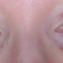 Surgery incisions on sub brow one week after surgery. Only surgery done was upper eyelid surgery, no brow lift.