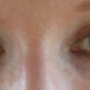 After, very natural 2 months after surgery with a little makeup.