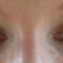 After, looking down 2 months after surgery. Any redness will disappear totally after about 6-9 months, no makeup necessary after.