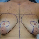 Presurgery markings