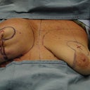 Half way through surgery