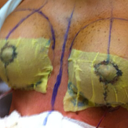 4 days post-op.  Drain removal day.