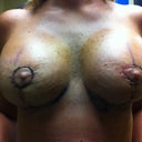 Day 17 post-op before my implants dropped.  Still lots of swelling in this photo.