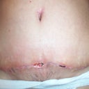 3 weeks post op, "holes" begin to split open after getting an infection.