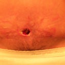 4 weeks post op, after dry wicking the "hole"  you can see how it is closing from the inside out. (This pic. looks odd b/c I forgot to turn on the flash!)