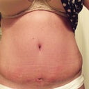 6 weeks post op, holes getting smaller, but I am very swollen as you can see!