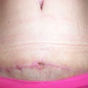 8 weeks, (2 months)  post op.