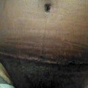 Scar pic
