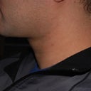 37 Year Old Male Treated For Skin Lifting And Tightening