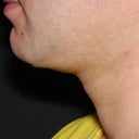 37 Year Old Male Treated For Skin Lifting And Tightening