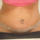 Almost 3 weeks out. It looks like the line is slightly lower than my c-section scar.