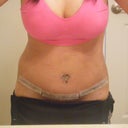 Full body shot.  I had two pop cans worth of lipo done.