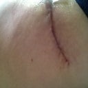 12/14 Hip scar