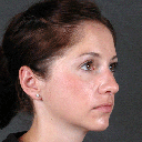 Rhinoplasty