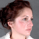 Rhinoplasty