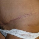 scar 9 weeks