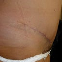 scar 9 weeks