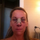 1 day post op. Swelling bruising are starting to go up more. Upper lip is stiff