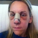 Day 3 post op. I don't even look like myself. Cheeks and whole face are very very swollen! I have peaked with swelling here.